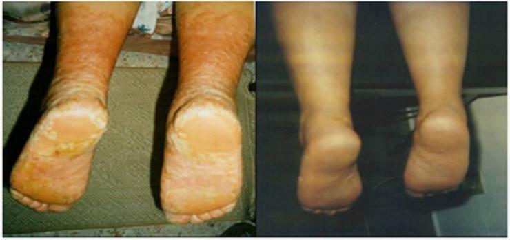 Losterin la crema a atopicheskom la dermatitis