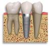 Foto de Diseno odontologico - implantes endodoncia cirugia