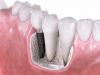 Foto de Implantes dentales-dentista