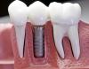 ICoDent-implantes dentales