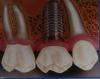 Endoperio-implanto. Clinica dental