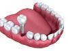 Foto de Estetic Implant - Implantes Dentales